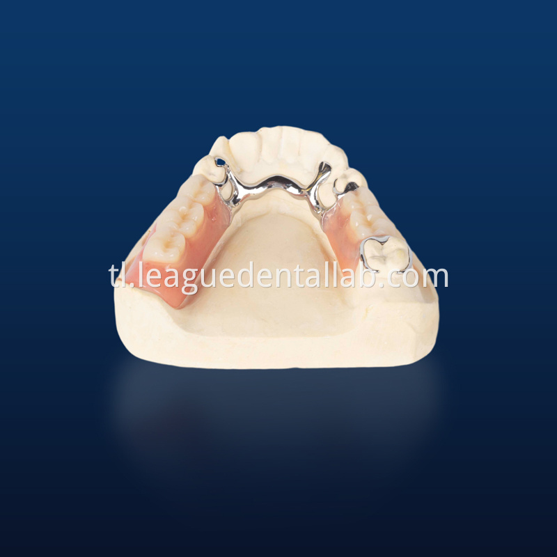 Cast partial,3D printed metal partial,Bego metal partial,cast metal framework,Vatalium Metal framework